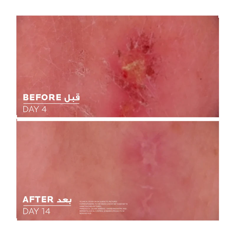 La Roche-Posay Cicaplast Baume B5+ – Ultra Repairing & Soothing Balm for Sensitive Skin