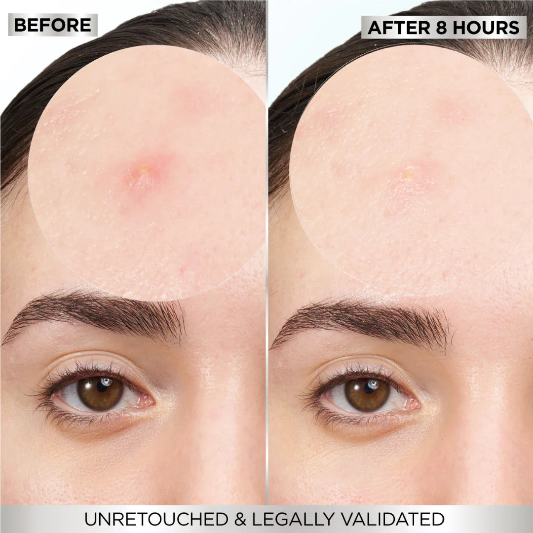 Garnier Skin Active Fast Clear Invisible Pimple Patch 8 Hours Hydrocolloid 22Patches