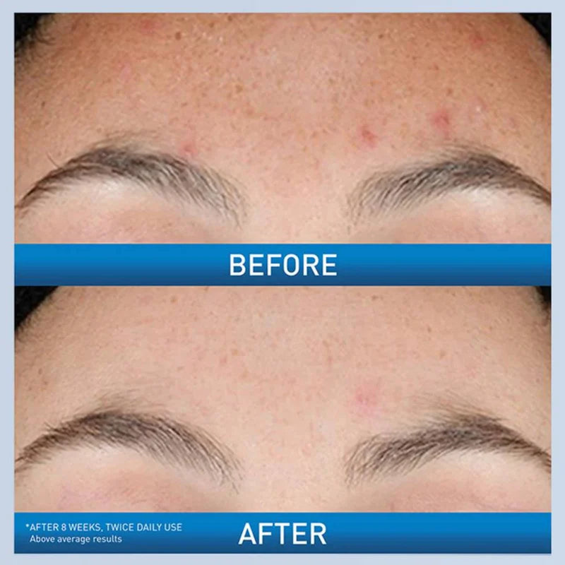 CeraVe Resurfacing Retinol Serum – Reduce Post-Acne Marks & Smooth Skin